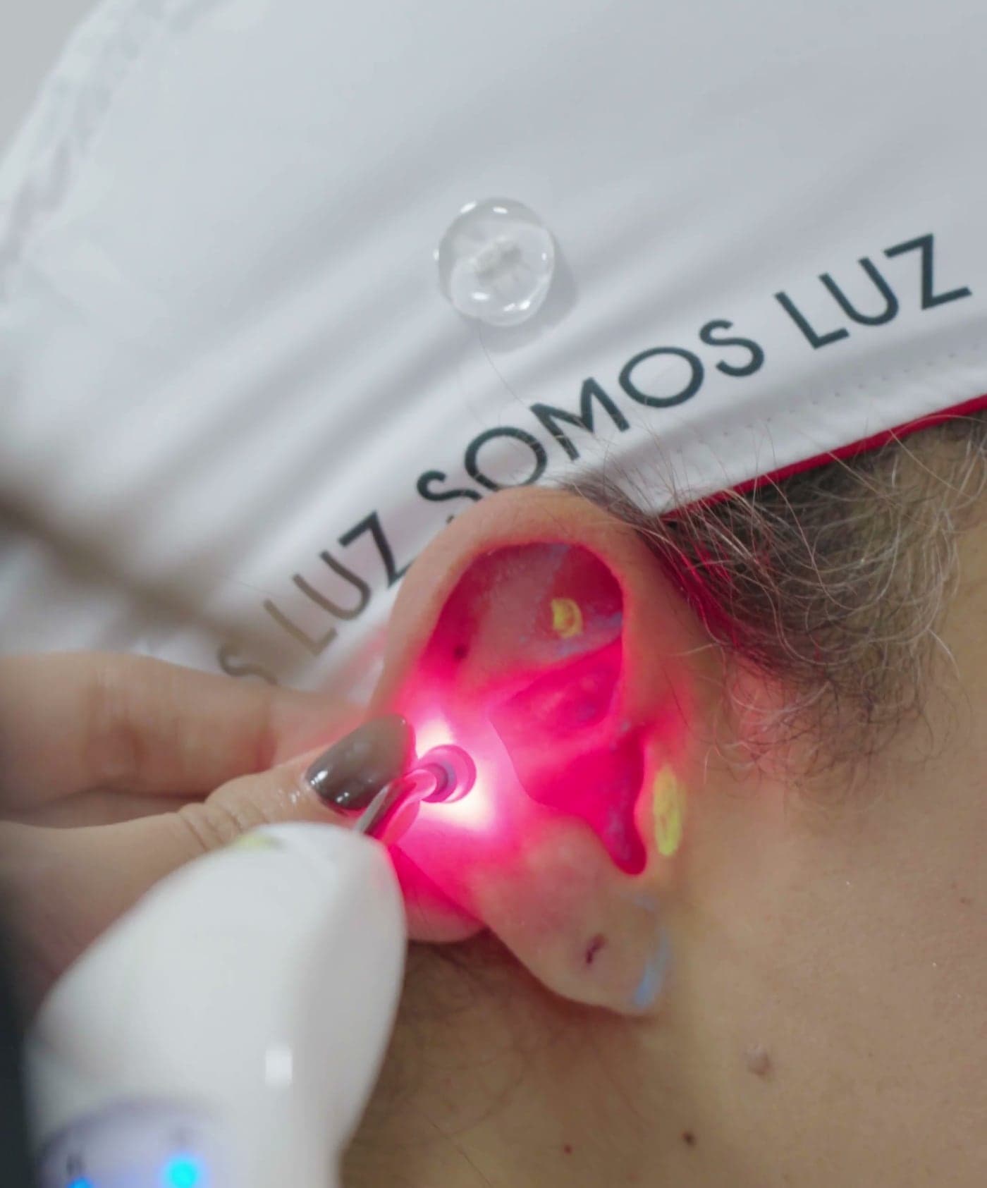 Aplicación de láser rojo en el pabellón auricular